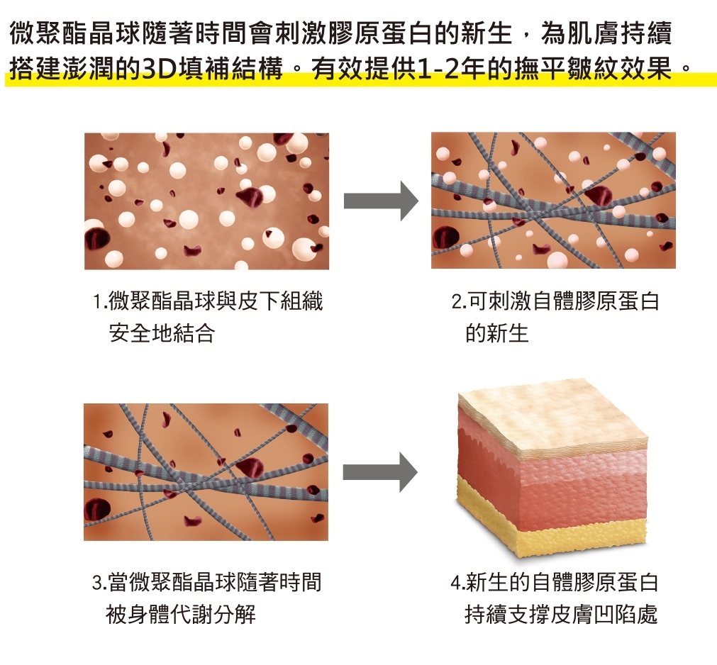 Ellansé洢蓮絲注意事項 自然膠原蛋白增生