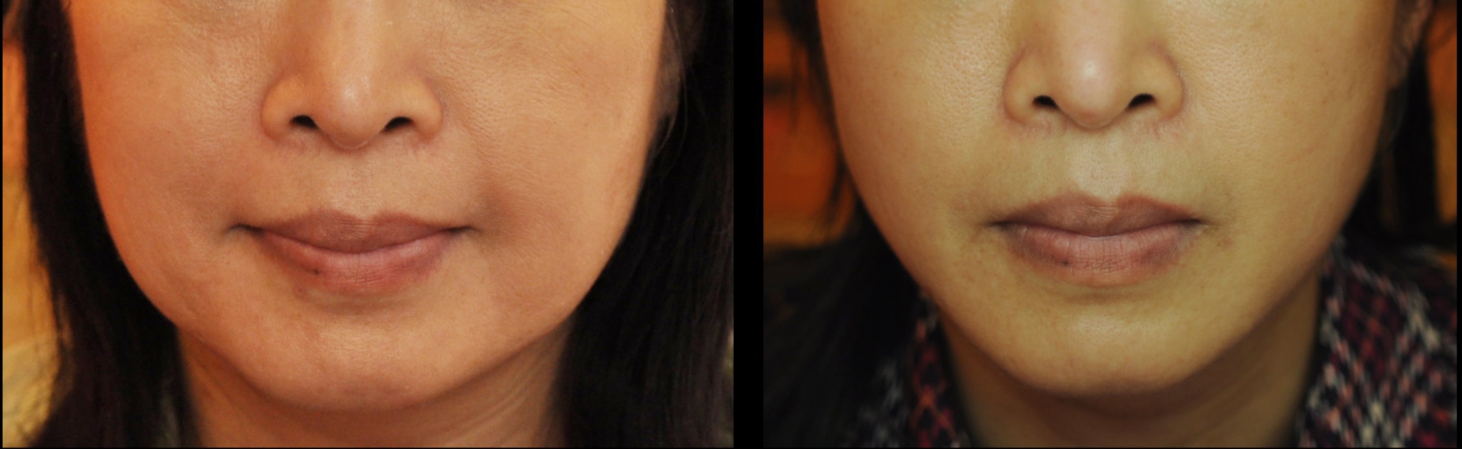 臉部雷射溶脂 案例 1