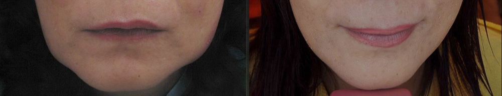 臉部雷射溶脂 案例 2