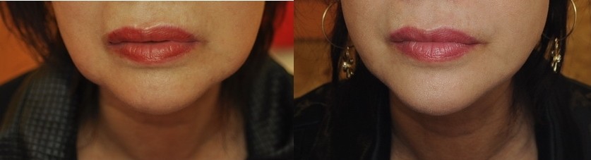 臉部雷射溶脂 案例 4